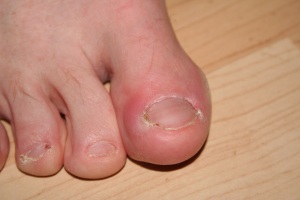 Ingrowing toenail